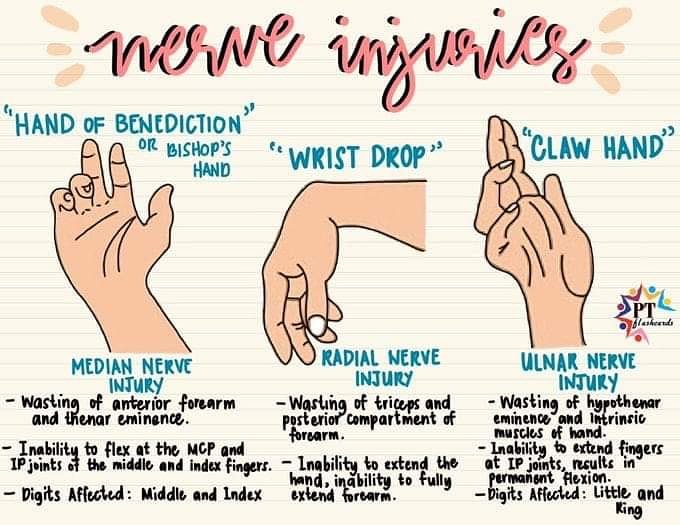 How great are these #PTFlashcards! A great refresher of upper limb nerve injuries and their presentations #medianNerve #radialNerve #UlnarNerve