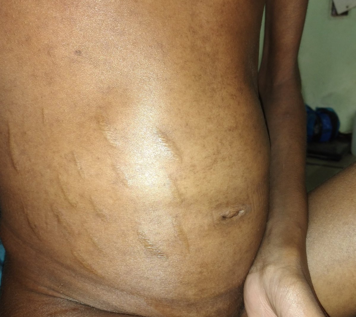 Onyebaby7's tweet image. Please everyone,  I need your help...this pain is too much for me. I'm a sickle cell patient that needs urgent attention. Please help me