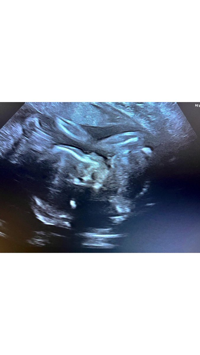 SimmerChlo's tweet image. 4 months til I meet my princess