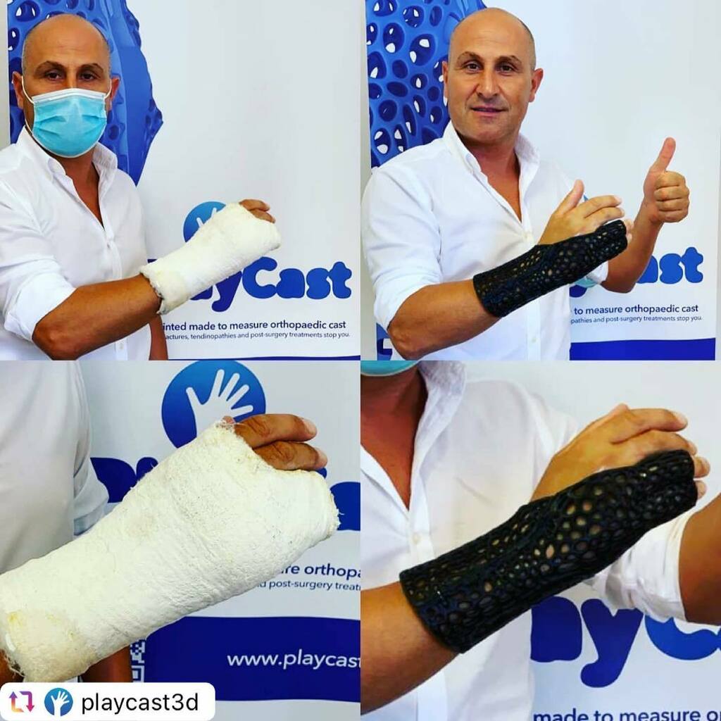 3dheals's tweet image. #Repost @playcast3d 
396 grammi di gesso tradizionale sostituti con 78 grammi di plastica riciclata e al 100% riciclabile, questo è #PlayCast
#gesso3d #tutore #ecofriendly #riciclare #stopgesso #futurosostenible #leggero #traspirante #eco #design
