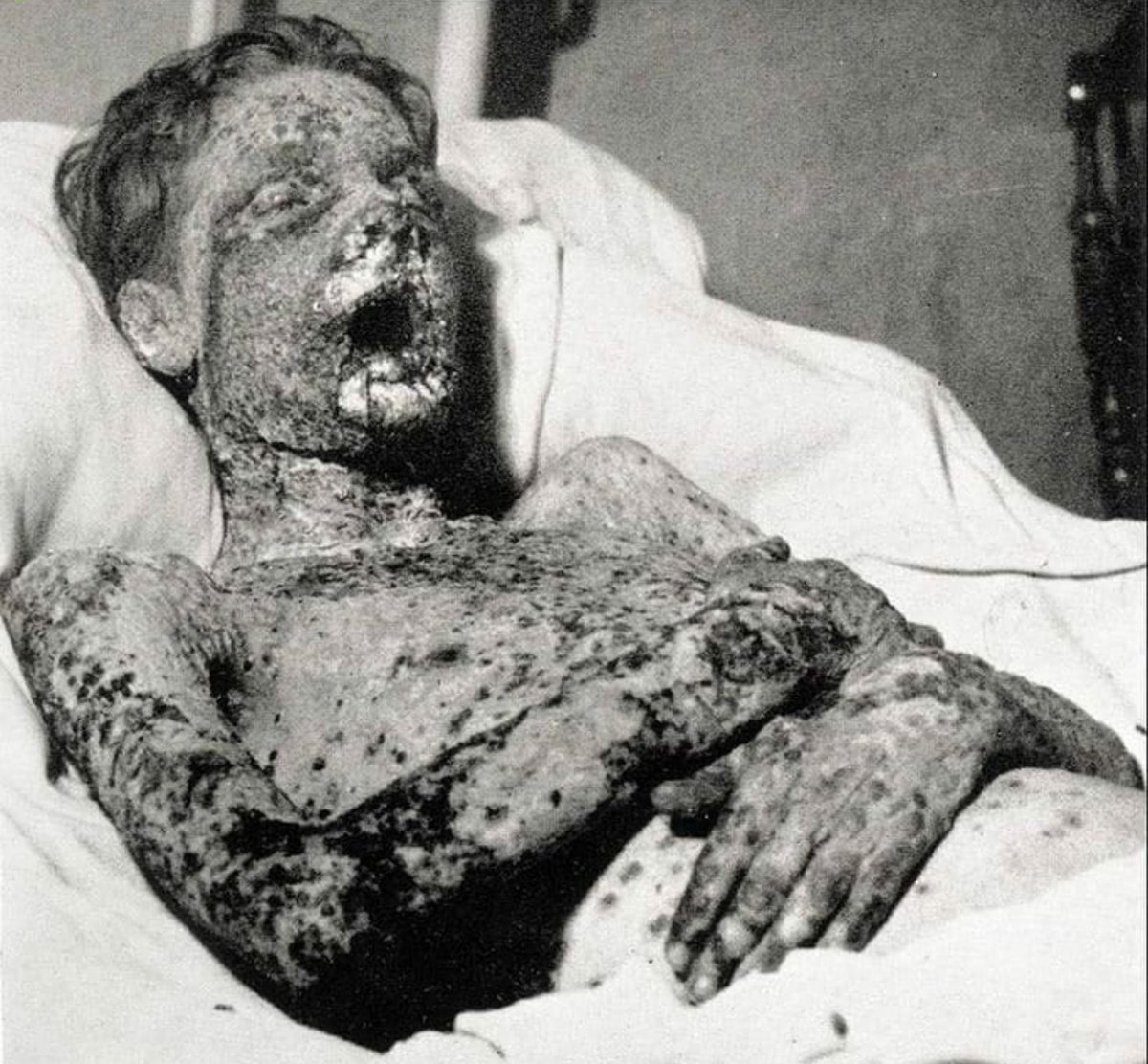 historyandfacts's tweet photo. Smallpox before the 1960s vaccines. https://t.co/tn7anH1TWV