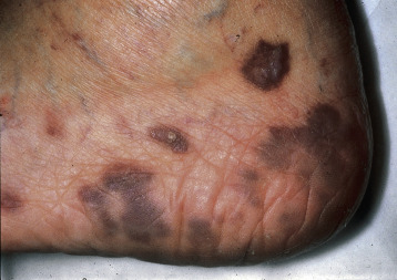 BCMIDFellowship's tweet photo. 26/‼️ Don’t forget that bacillary angiomatosis can appear similar to Kaposi sarcoma (KS)
🔸KS lesions: red-purple nodules or plaques 👉
🔸Biopsy needed for diagnosis https://t.co/RWymnrl3FY