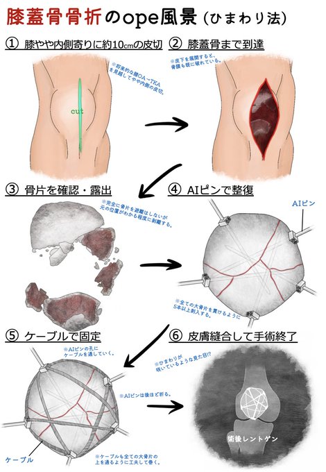 膝蓋骨骨折のtwitterイラスト検索結果 膝蓋骨骨折のtwitterイラスト検索結果
