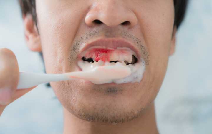 🤗you can stop it..blood on brush🤗
1. Brush your teeth gently for two minutes  
2. Do it twice a day: morning after breakfast and evening after dinner
3. Rinse your mouth with a mixture of moderately hot water and salt after brushing.
#oralhealthtips