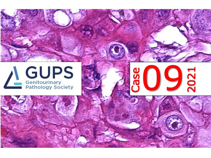 A woman in her mid-40s with a kidney tumor underwent radical nephrectomy. 

Contributor: Athanase Billis

The @GU_Path_Society Case of the Week is LIVE: gupathsociety.org/COW-2021-09

Send your cases to @FKhaniPath 

#GUpath #pathology #kidneycancerawareness