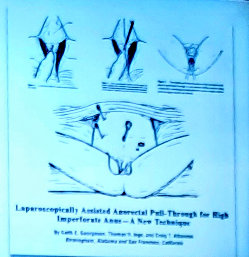 TauliCIRPED's tweet photo. Seguimos con la actualización en #ARM con @bth_josue sobre
"Manejo laparoscópico de las Malformaciones Anorectales" y sus indicaciones, con una visión crítica.
Laparoscopic Assisted Anorectal Pullthrough
#LAARP Vs #PSARP
#SoMe4PedSurg https://t.co/1XdHor1ROm