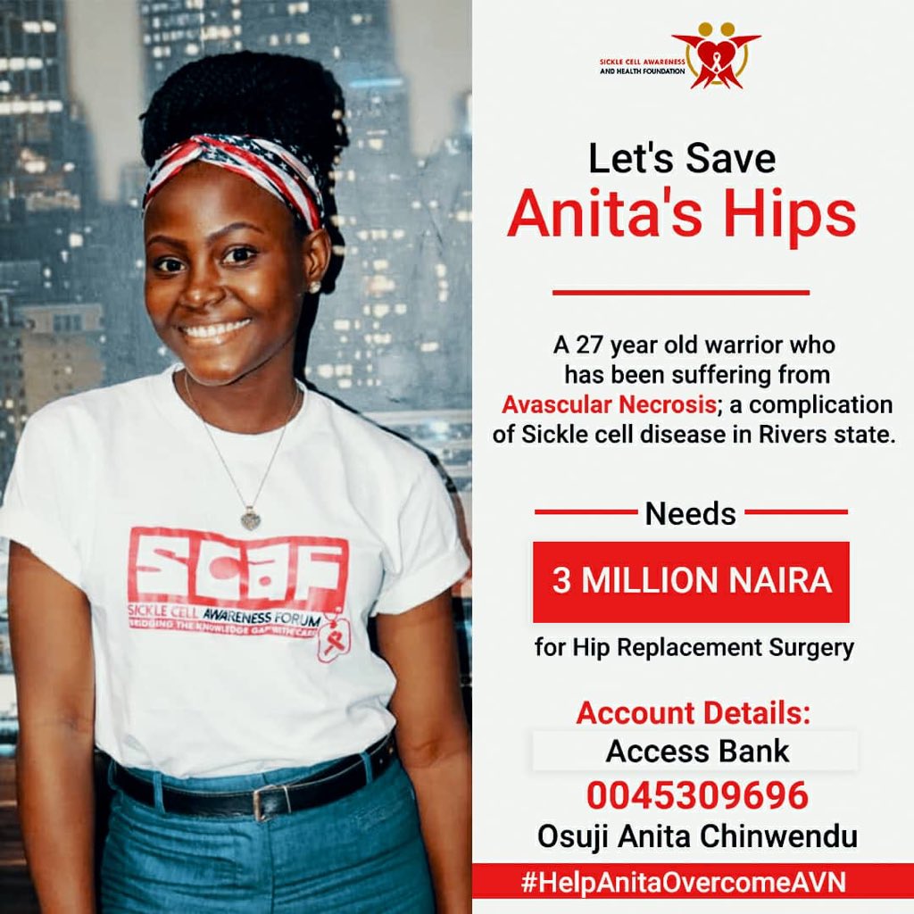 beebeeaana's tweet photo. Good evening everyone, I want to talk about a friend and a follow volunteer Anita who has AVN and would be needing two hips replacement surgery so she can walk again... AVN is a complication that affect people leaving with SCD... 
please Donate and Also help Retweet 🙏🏿🙏🏿🙏🏿🙏🏿 https://t.co/aKaHyaiqWa