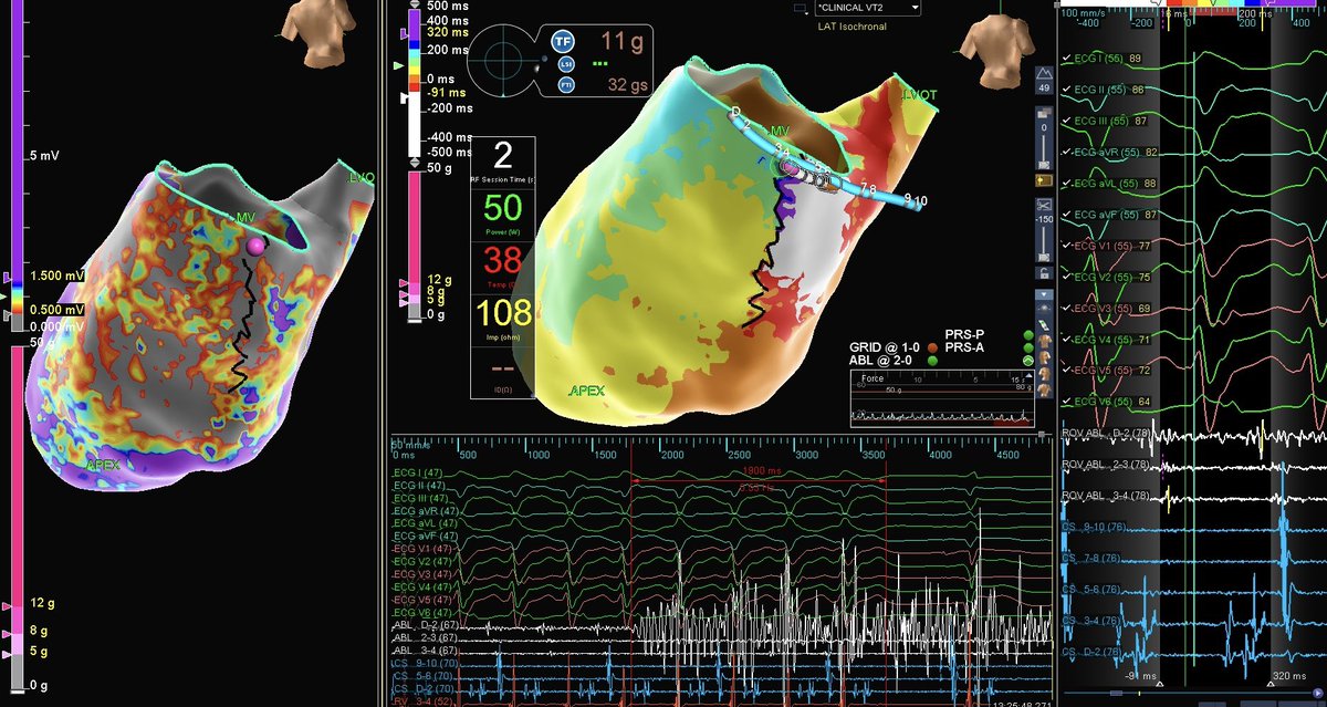 EPbytheBay's tweet photo. What’s better than a two second VT #OneBurnTerm ?! #HDGrid easily pinpointed entire ischemic VT circuit. Check out those mid-diastolic signals on the CS to make up the entire reentry cycle length! @AbbottCardio #ablateVT https://t.co/HdW76VC2f3