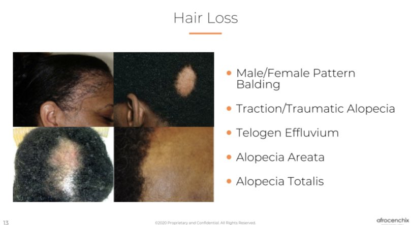 I get upset when I see those suffering with alopecia be sold lotions and potions that:A) they don’t need as the hair was growing backOrB) won’t work because their follicles are goneSee a doctor or trichologist if you have major hair loss or any severe itchiness or scarring.