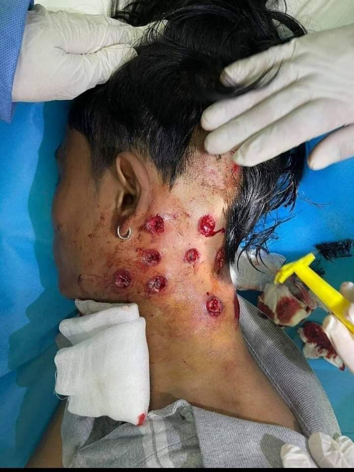The frightful impact of rubber bullets fired at close range - by Myanmar security forces. 

#WhatsHappeningInMaynmar #MyanmarCoup
