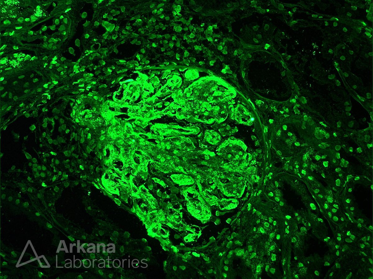 What is your diagnosis (IgG stain shown)?  #renalpath #pathtwitter