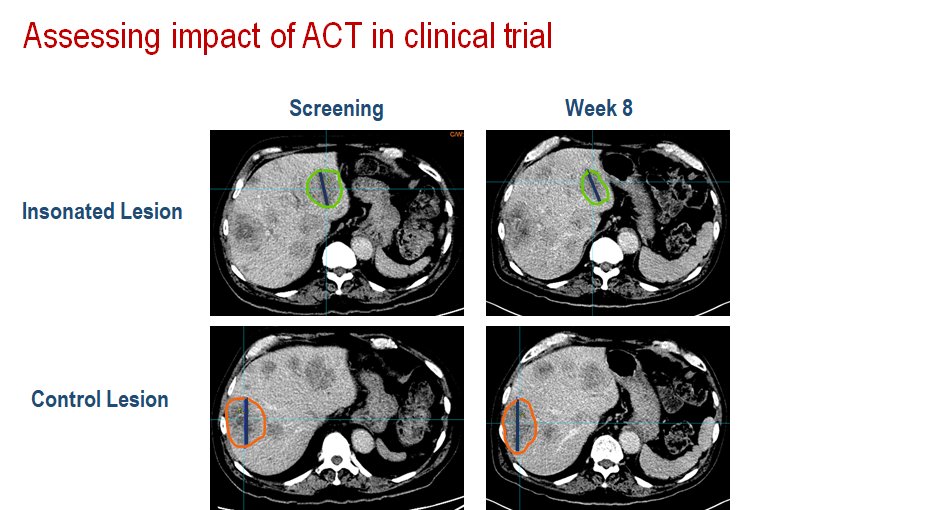 udaibanerji (@udai_banerji) on Twitter photo Where physics, chemistry, biology and clinical science meet in a single trial. Presented on Acoustic Cluster Therapy at #ESMOTAT2021. Thank you to all patients and families, trial staff, researchers and funders. <a href="/ICR_London/">The ICR</a> <a href="/royalmarsdenNHS/">The Royal Marsden NHS Foundation Trust</a> <a href="/ECMC_UK/">ECMC Network (@ecmc-uk.bsky.social)</a> <a href="/NIHRresearch/">National Institute for Health and Care Research</a> @ExactTx Where physics, chemistry, biology and clinical science meet in a single trial. Presented on Acoustic Cluster Therapy at #ESMOTAT2021. Thank you to all patients and families, trial staff, researchers and funders. <a href="/ICR_London/">The ICR</a> <a href="/royalmarsdenNHS/">The Royal Marsden NHS Foundation Trust</a> <a href="/ECMC_UK/">ECMC Network (@ecmc-uk.bsky.social)</a> <a href="/NIHRresearch/">National Institute for Health and Care Research</a> @ExactTx