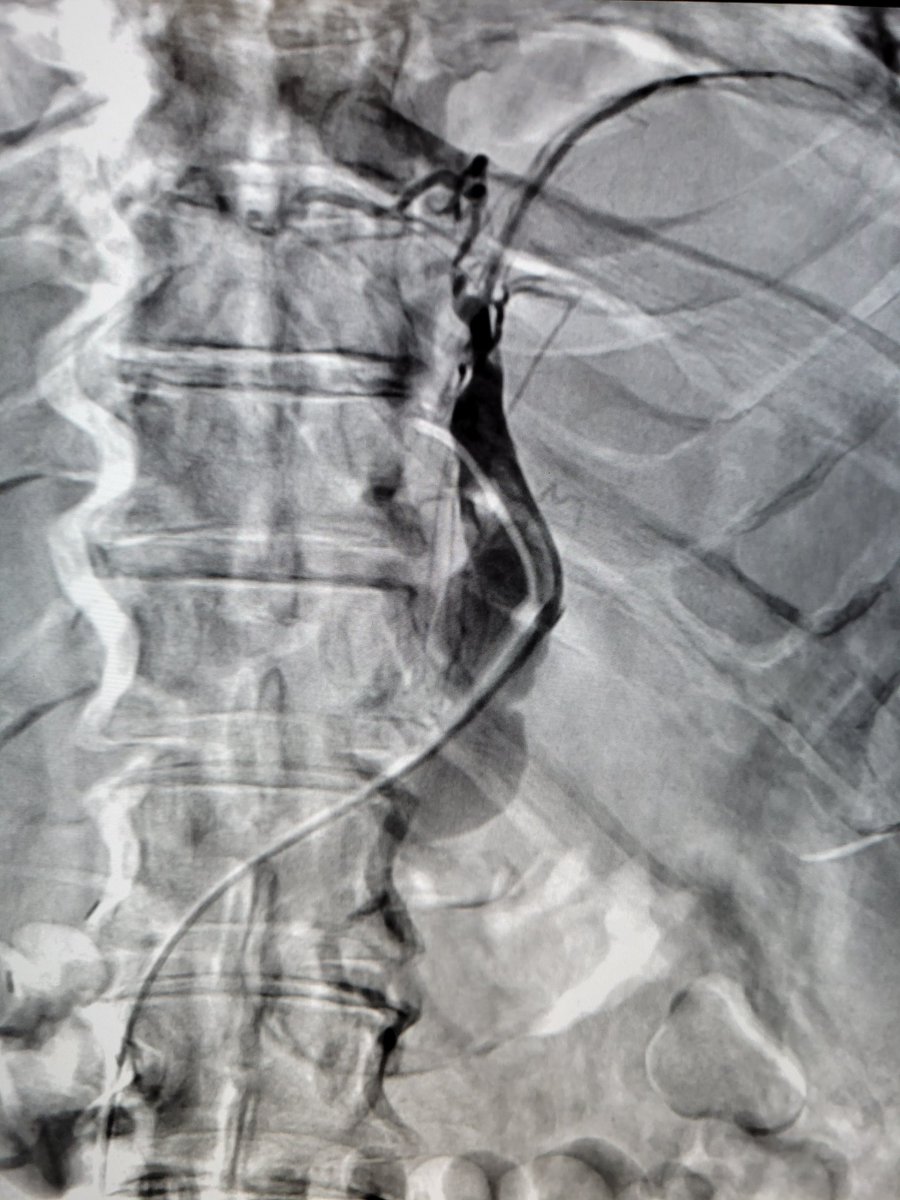 TempleRADs's tweet photo. Patient with plump bleeding gastric varices and splenorenal shunt. CARTO performed with long sheath, paired microcatheters, microcoils and gelfoam slurry to stasis. Beautiful result by Dr. Panaro and @Nmontec2. @TempleRadRes @SIR_ECS @SIRRFS @SIRspecialists #IRAD https://t.co/s7nYBCUJ5h