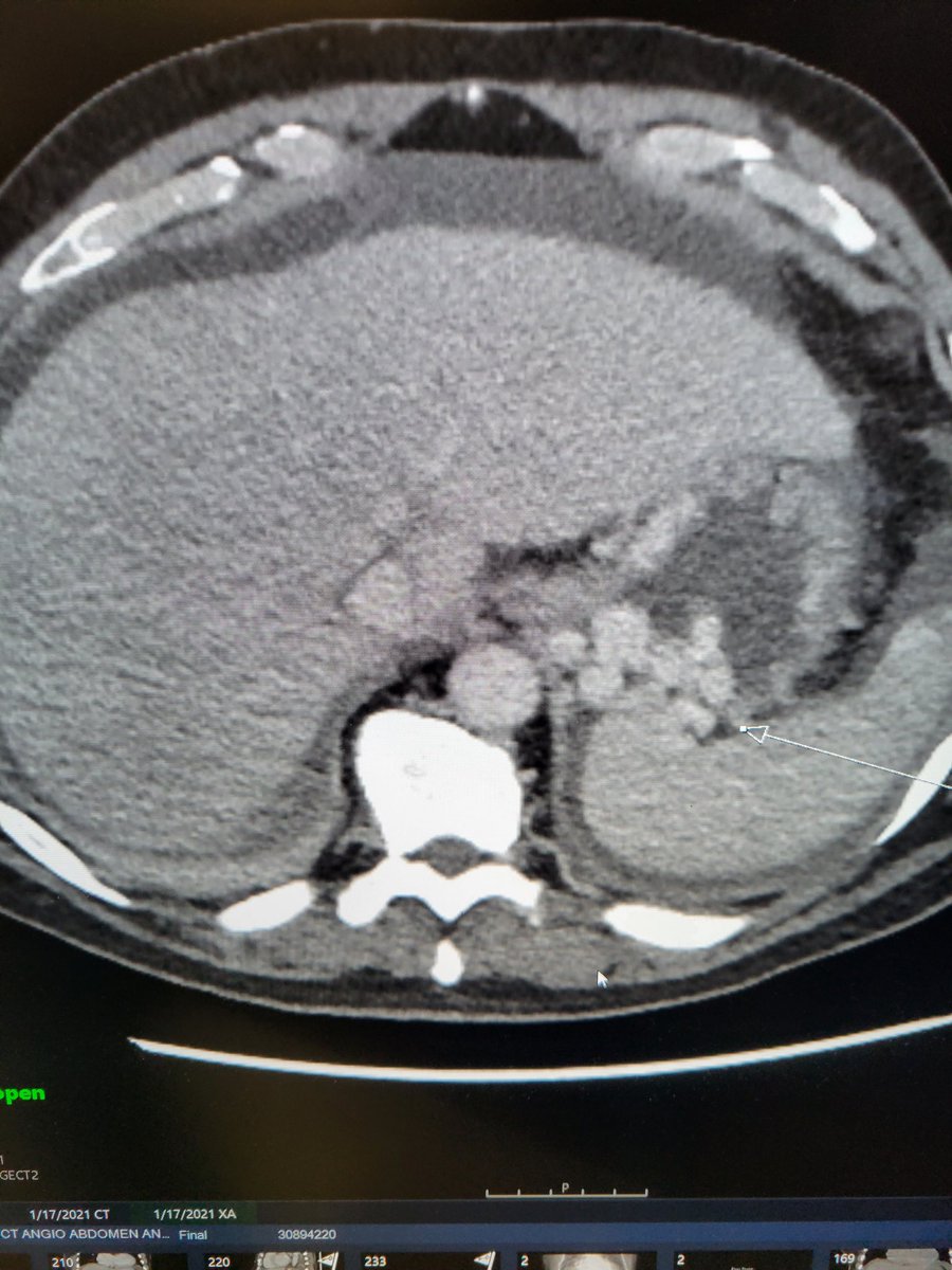 TempleRADs's tweet photo. Patient with plump bleeding gastric varices and splenorenal shunt. CARTO performed with long sheath, paired microcatheters, microcoils and gelfoam slurry to stasis. Beautiful result by Dr. Panaro and @Nmontec2. @TempleRadRes @SIR_ECS @SIRRFS @SIRspecialists #IRAD https://t.co/s7nYBCUJ5h