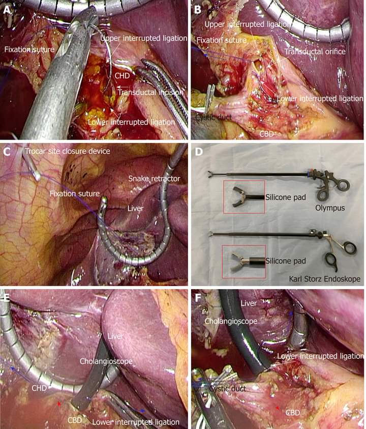 Biliary system and actual surgical procedures of laparoscopic choledocholithotomy .
#SoMe4IQLatAm #SoMe4Surgery
 wjgnet.com/1007-9327/full…