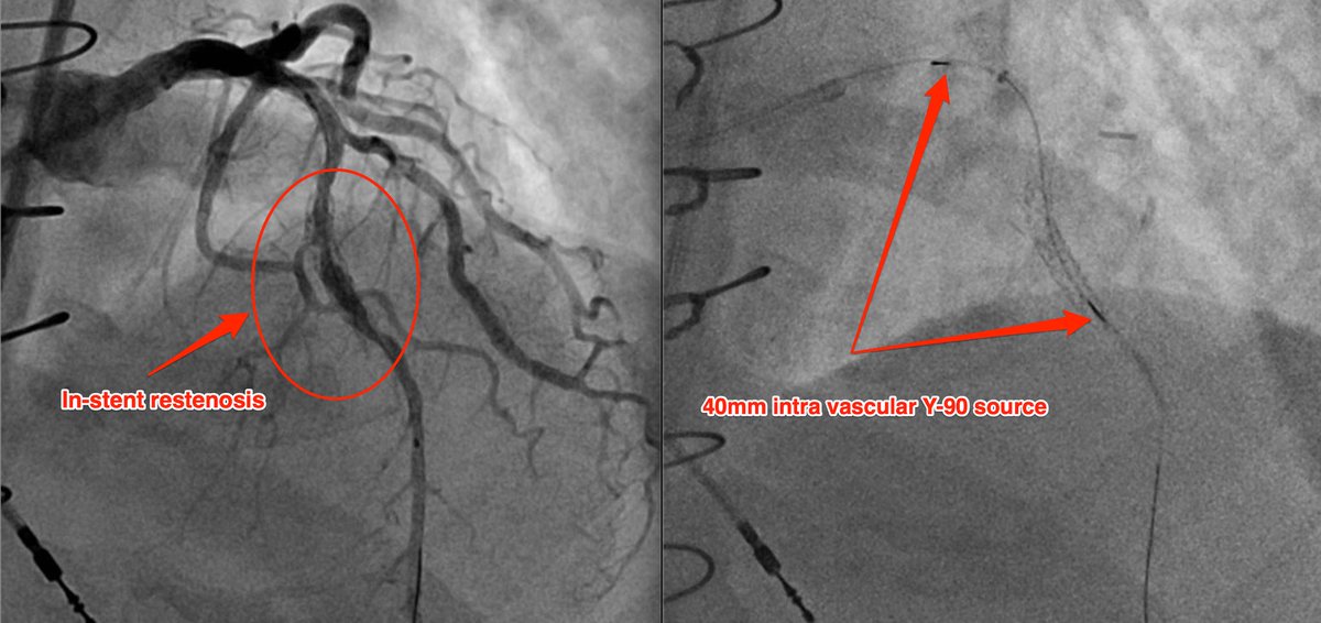 sheencherianMD's tweet photo. Proud to be part of the Intravascular Brachytherapy Team at Cleveland Clinic #IVBT @CleClinicMD @DrJohnSuh @ARRO_org https://t.co/mic5yn9Gk9