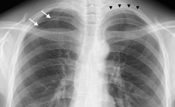 MarcGozlan's tweet photo. Pneumothorax bilatéral après #acupuncture pour raideur de l'épaule chez une patiente (1,58 m ; 42 kg). Utilisation d'une aiguille de 60 mm. La distance entre l'épiderme et la plèvre viscérale au niveau du muscle élévateur de la scapula n'était que de 22 mm https://t.co/ldgI1XBYQt https://t.co/8pvzsIN2dS