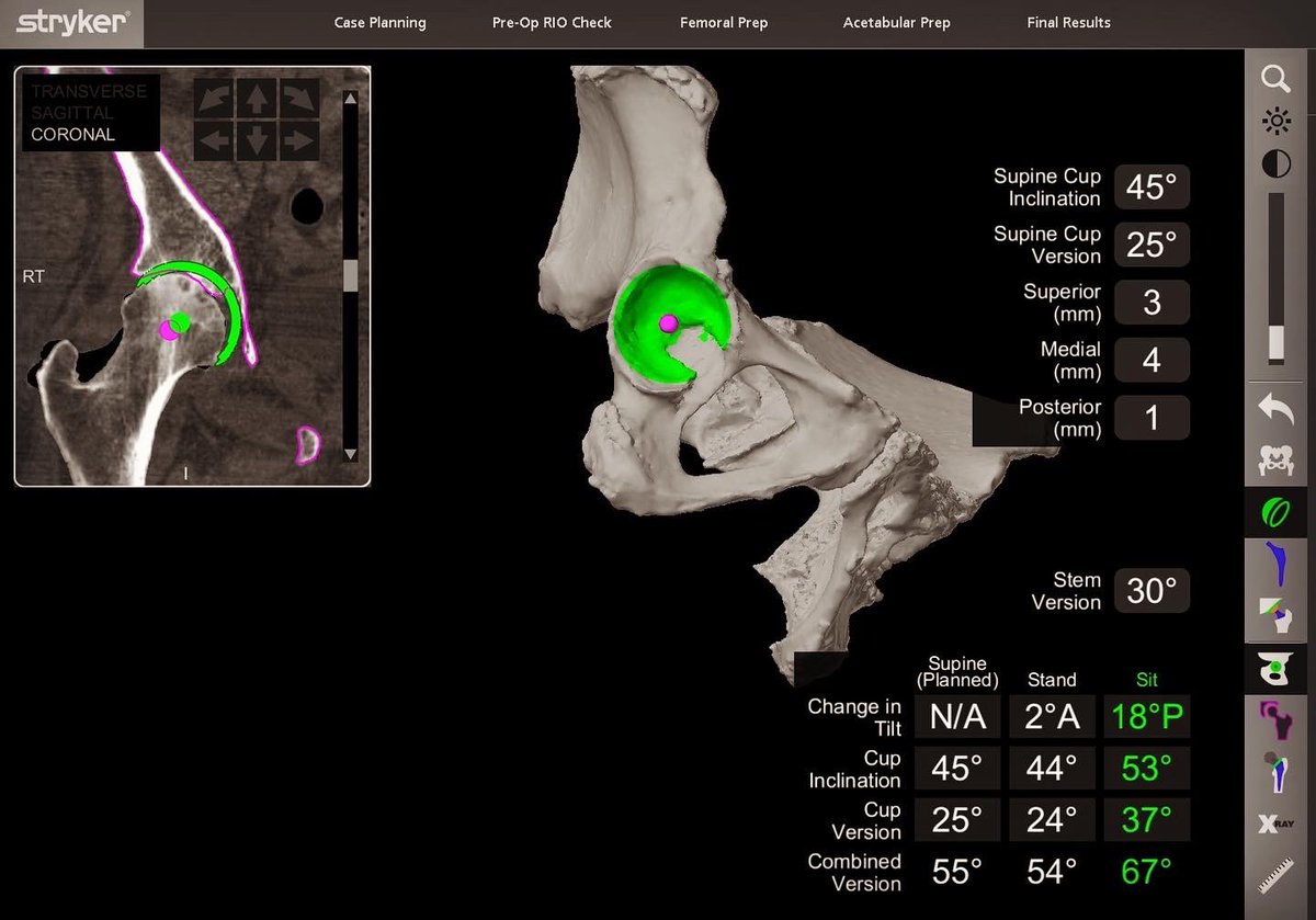 Taking it to the next level In #totalhipreplacement surgery

#makomonday featuring my utilization of mako 4.0 technology <a href="/PH_SportsMed/">Penn Highlands Sports Medicine</a> <a href="/pennhighlandshc/">Penn Highlands</a> 

Virtual modeling and preoperative planning to maximize the impingement free zone by dialing in your cup/stem position
