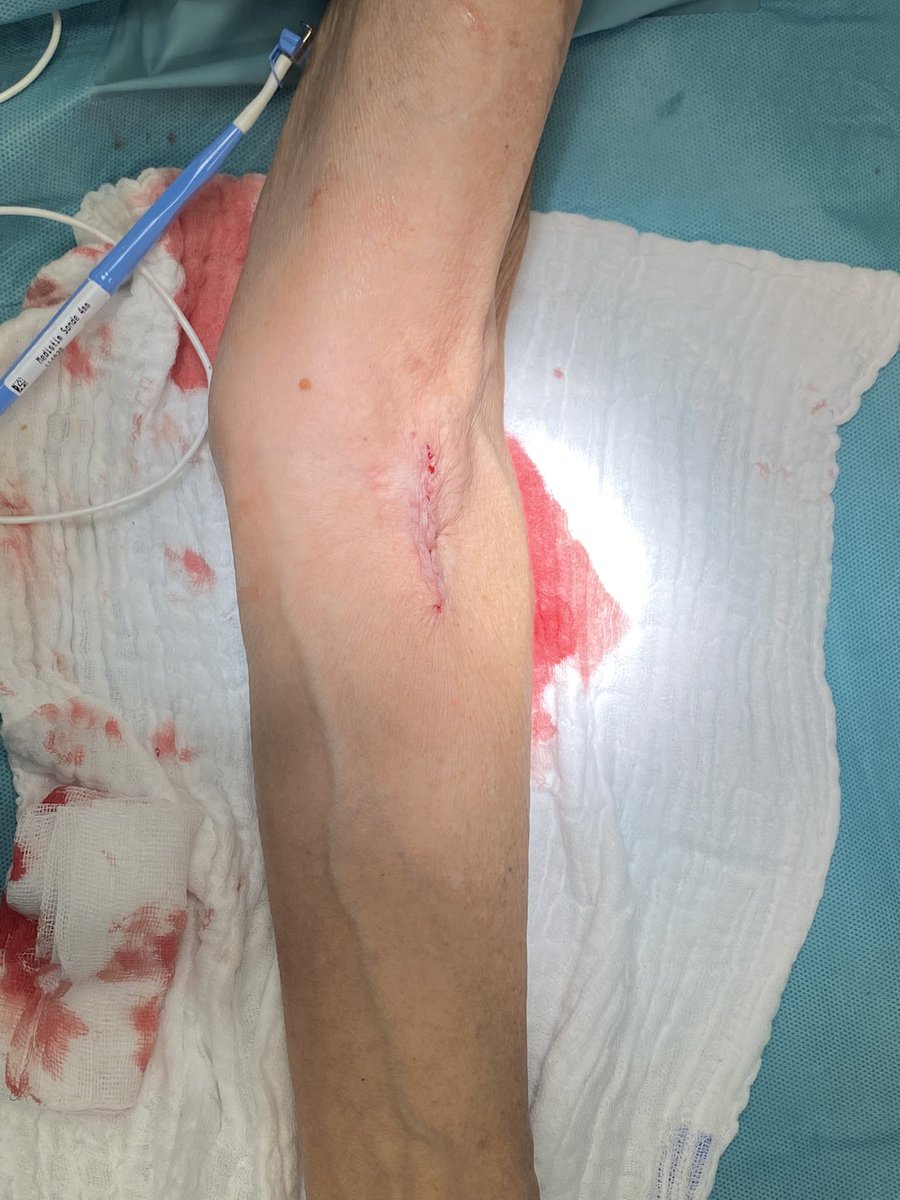 robshahverdyan's tweet photo. Here goes today’s #Gracz #sAVF created between the proximal radial artery and the perforator with 3 mm anastomosis: look at that flow & cannulation length! (Disclosure: no preexisting Vascular Accesses). #controltheflow #vascularaccesscenter #hamburg https://t.co/0XSk3NZ8Qn
