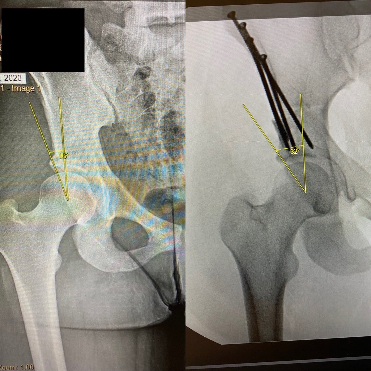 CraigASmithMD's tweet photo. Saving hips in Columbus! #savethehip #hippreservation #orthotwitter #osuortho #nationwideortho #pedsortho @wkvasileff https://t.co/8lZgZzs7Ct