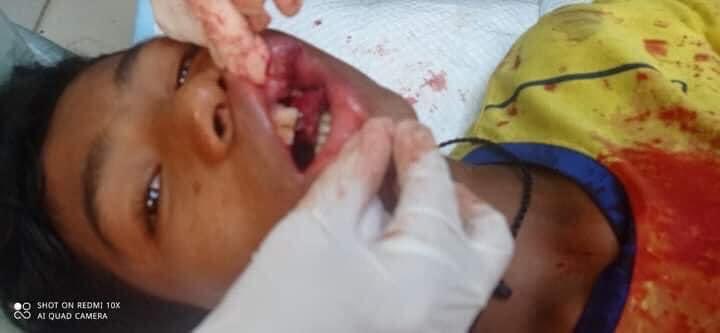 In Myeik,bullet hit his mouth yesterday!
TW//Blood #WhatsHappeningInMyanmar #Mar1Coup