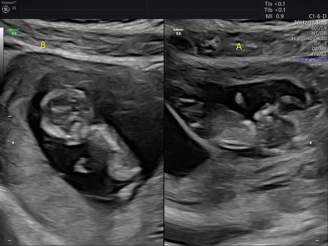 NadiaGa_24's tweet photo. We are not
Only being blessed with one baby we are happily blessed with twins❤️👶👶
Baby A heartbeat is 163❤️
Baby B is 159 ❤️ https://t.co/rTLpBoDTrR