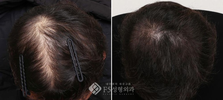 f5_scalp's tweet image. F5頭皮クリニック | 30代男性の薄毛・ヘアタトウー(SMP)の症例
⇒ameblo.jp/f5scalp/entry-…

#F5整形外科 #韓国整形 #脱毛 #ヘアタトゥー #薄毛 #脱毛症 #SMP #抜け毛 #ミノキシジル #脱毛症治療 #植毛