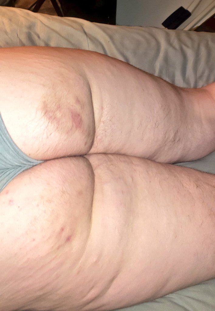 Bruises from the weekend. How does it look? My butt was hurting real good this morning 😅. https://t.co/RzrZ8cZQbY