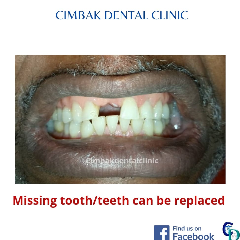 Cimbakdental's tweet photo. A missing tooth can certainly change the appearance of your smile. Whether a missing tooth is the result of gum disease, injury, severe tooth decay, or a genetic condition, a missing tooth can cause several problems. Read more on IG https://t.co/RL4A1ka6cg 
#PHTwitterCommunity https://t.co/HgrKcGjpJz
