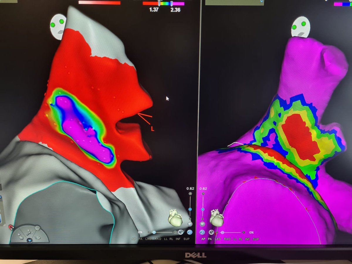 DrBerruezo's tweet image. Left Superior PV-to-LA Appendage Isodistance map and its correlation with the Far Field Bipolar Voltage Map  of the LA Appendage from inside the PV.
Specially for ADAS3D lovers!!!
#EPeeps