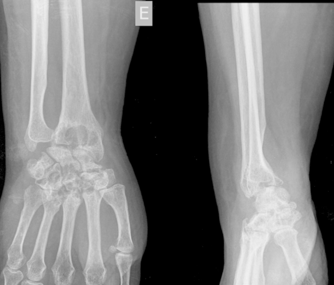 What’s New in Hand and Wrist Surgery

ow.ly/dtrS50DMPHz

<a href="/ChrisDyMD/">Christopher J. Dy MD MPH FACS</a>