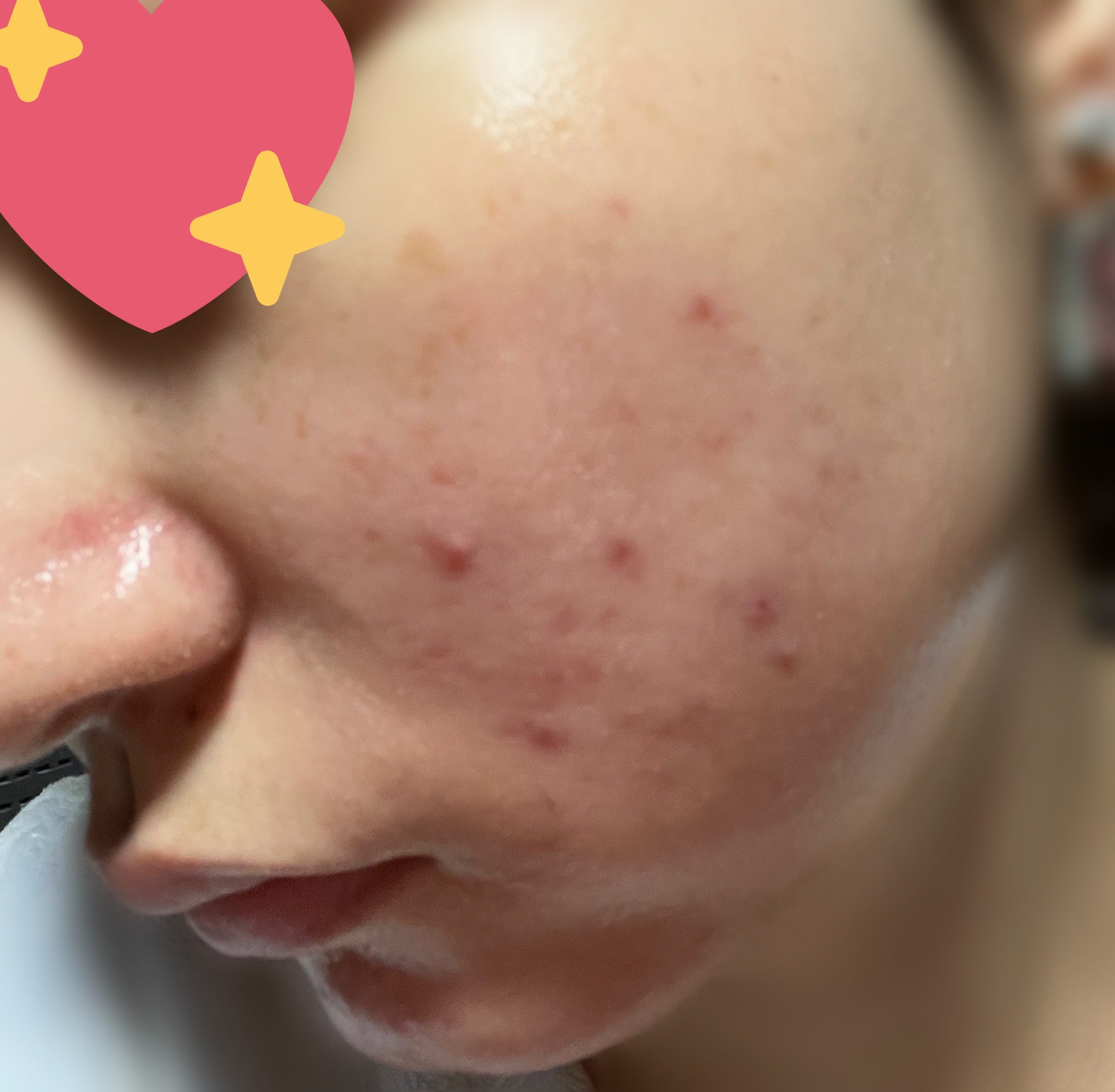 あお 初めて載せてみる Iphoneノーマルカメラです 鏡で見るのと写真じゃやっぱ違うな あとこれほとんどニキビ跡なんだなんだよね でも前と比べたら全然良くなってきている T Co Oirh9ih1m6 Twitter