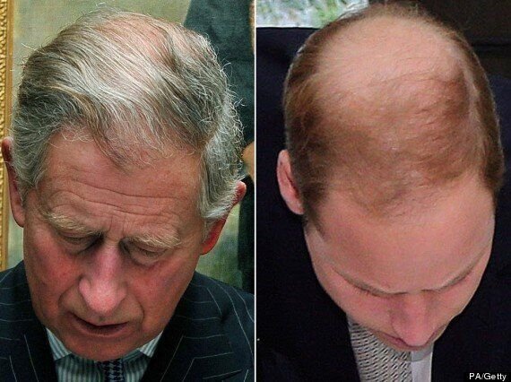 Exhibit 44:  #HairLossGateMost people would say male hair loss is caused by testosterone and is genetic. Not so the Express who've decided Harry is losing his hair because of his marriage. They've obviously not looked at the other men in the House of Windsor.