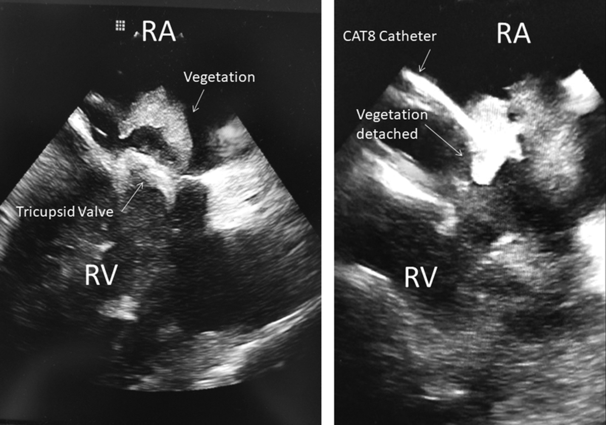 MyJSCAI's tweet photo. Percutaneous Debulking of Tricuspid Endocarditis in IV Drug Users:

-n=25 pts
-aspiration w/ 8 Fr system
-minimally-invasive alternative to surgical debulking
-survival to discharge 88%

https://t.co/xVxfplYRWV

Follow @CCIJournal, https://t.co/oEQYGHoWy4
@SCAI Official Journal https://t.co/saeGtI1tLS