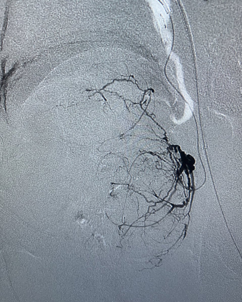 BPH pt with 633g prostate! Almost no surgical options. Other than bilateral groin access due to tortuous iliacs, very simple PAE. 75 min. 250 mGy. Pt reports very few symptoms the next day. <a href="/SandeepBaglaMD/">Sandeep Bagla MD</a> <a href="/JeremyKimMD/">Jeremy I. Kim, MD</a> <a href="/Matt_Raynor_uro/">Mathew Raynor</a> <a href="/keithppereira/">Keith Pereira MD, #VIrad</a> <a href="/kdpalli22/">Kavi Devulapalli</a> <a href="/SIRRFS/">SIR RFS</a> <a href="/SIR_ECS/">SIR ECS</a>
