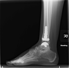 Did you know AOFAS endorses the use of total ankle replacement surgery to treat arthritic conditions of the ankle? Read the position statement: aofas.org/docs/default-s…