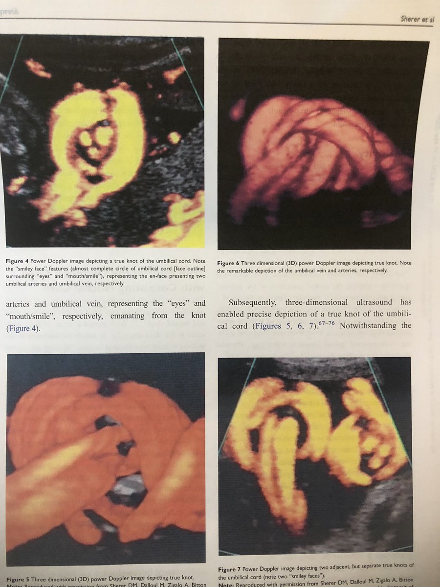 jcollinsmd77's tweet photo. OB Facts: There are numerous case reports showing UCA imaging and management. https://t.co/1cXd6YOmpt