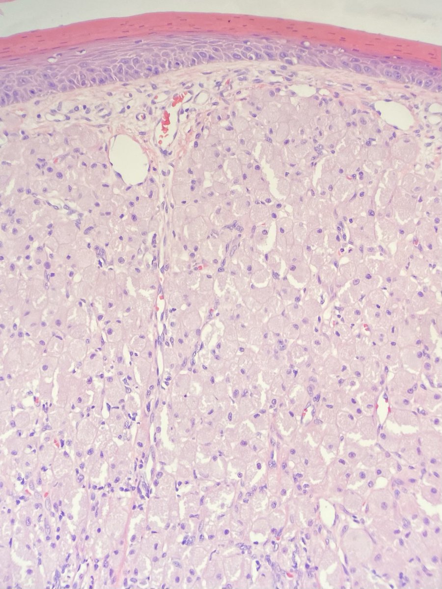 Another nice case from my resident unknown treasure boxes... gingival lesion in a newborn.  You don’t really need IHC to make this IPR dx, but if you did what might you order?