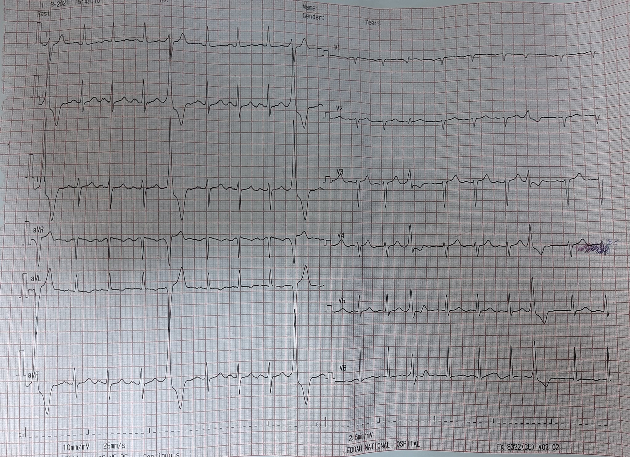 Ventricular Quadrigeminy
