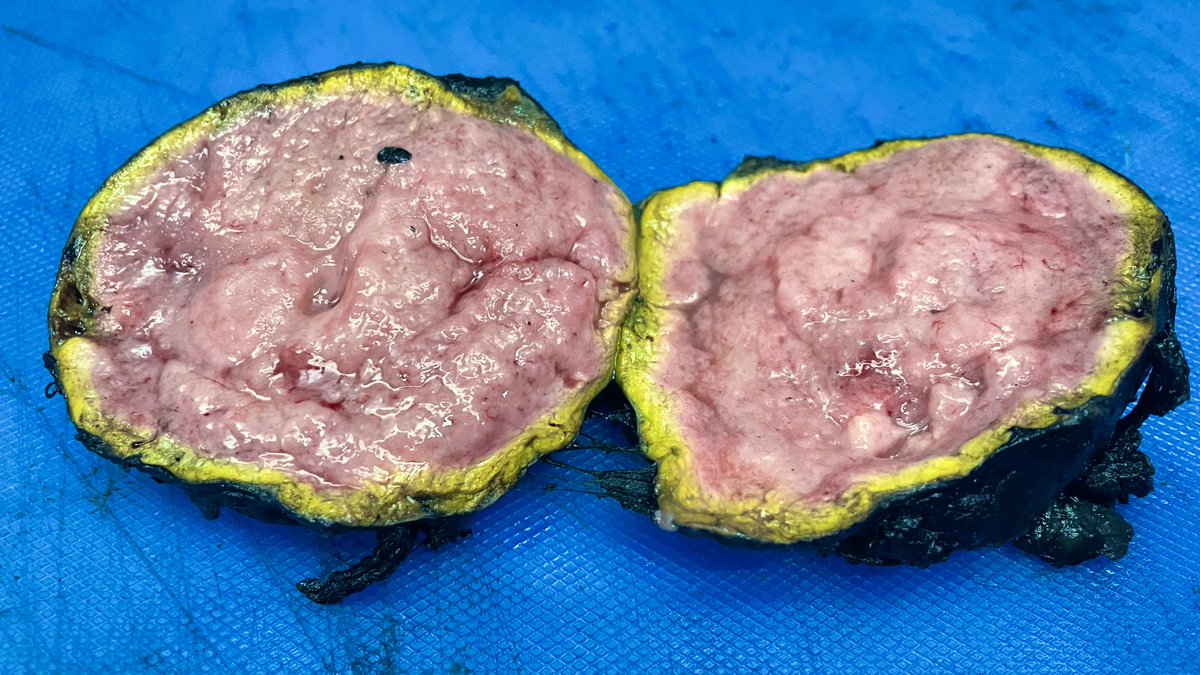 NidhinMd's tweet image. Adrenal mass, gross diagnosis? #twitterpath #PathTwitter #pathresident #pathology #grosspath #diagnosis