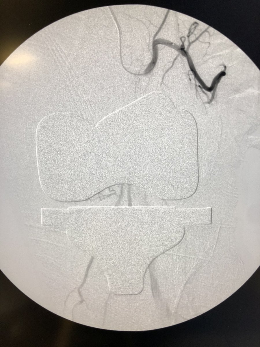 Who says <a href="/BostonPIMedEd/">Boston Scientific PI MedEd</a>’s TruSelect is only for #pae? Perfect for #gae too! Post L TKAx1yr w/ recurrent hemearthrosis and sup-lat pain - perfect angio correlate. Beads + 🧊=no pain/opioids, no revision. Helping fight the #opioidcrisis and ⬆️ #QoL with #orthotwitter colleagues.
