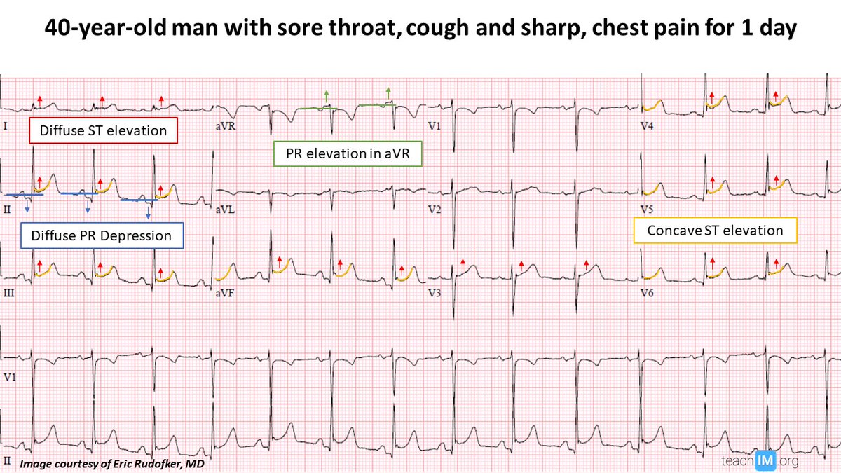 Check out this great interactive talk by <a href="/CUInternalMed/">CU Anschutz Internal Medicine</a> 's Chief Resident, <a href="/ERudofker/">Eric Rudofker</a>, to get the rub on this classic EKG finding. Never be fooled by #pericarditis again. 

#TeachIM #MedTwitter 

View more: teachim.org/pericarditis
