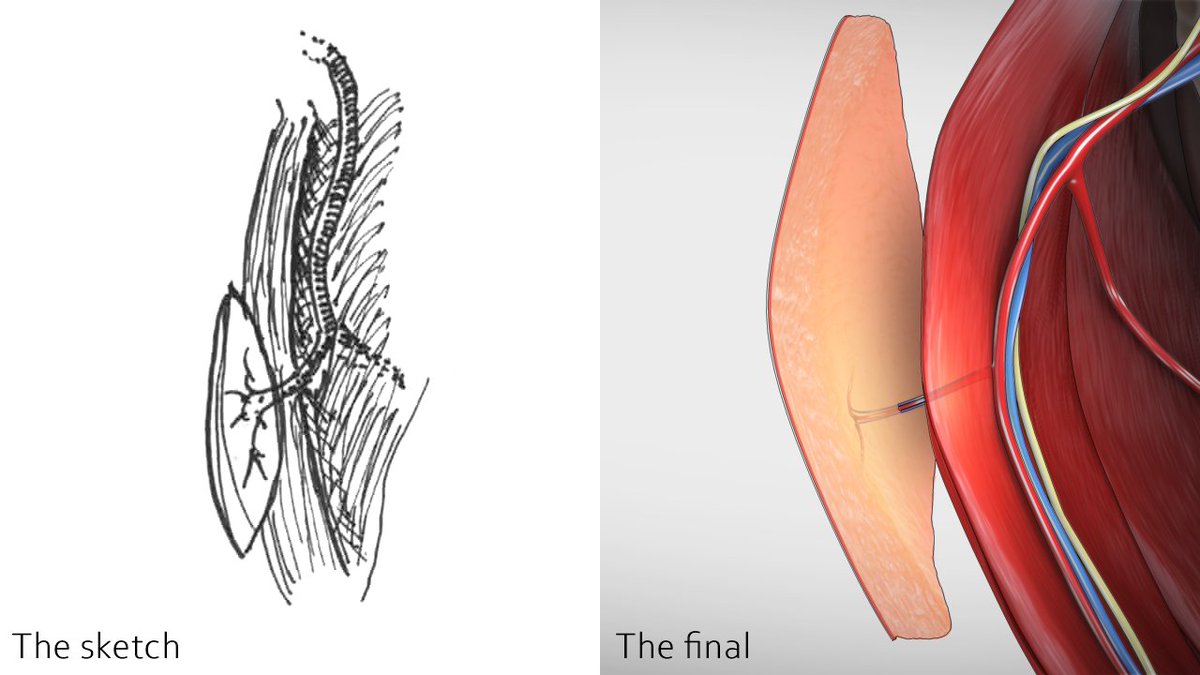 #BehindtheScenes for our TDAP flap harvest video, used in #reconstructiveSurgery and #headAndNeckSurgery.

Full video available here:
pie.med.utoronto.ca/TVASurg/projec…

#medart #sciart #SoMe4Surgery