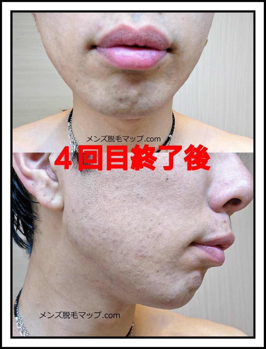 メンズ脱毛マップ Com Com Twitter