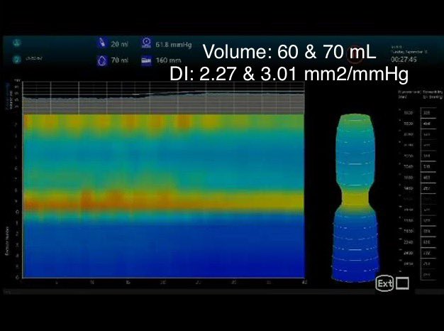 WalterChanMD's tweet photo. #TracingTuesday
60 year-old man w/ dysphagia presented for upper endoscopy, which was normal w/ no stricture or mucosal abnormality. FLIP analysis was performed using the 16 cm device.
How would you interpret the FLIP findings?
(👉 last image representative of both 60 & 70 mL) https://t.co/f5CkywAcxk