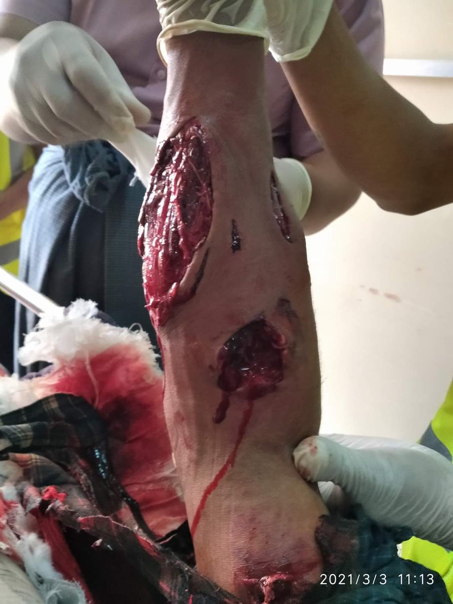 Today in Magway,
Juntas shoot computer university student by real bullet.
tw//blood/wounds
#WhatsHappeningInMyanmar 
#Mar3Coup