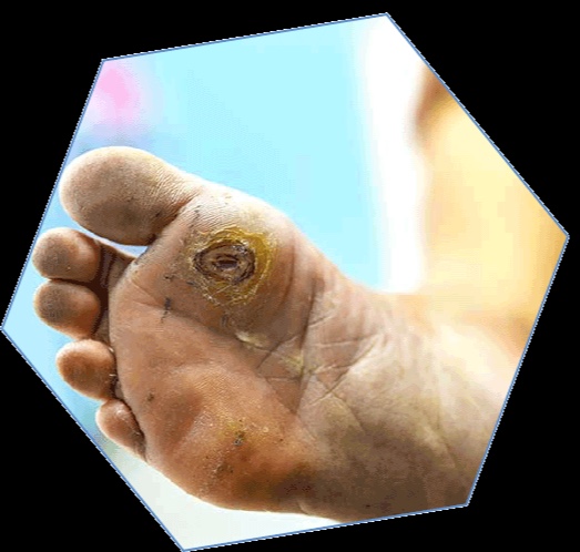 We are recruiting now for our extended trial in Loughborough with  <a href="/LPTresearch/">LPT Research Team</a> for the RAPID 1 Trial for the treatment of diabetic foot ulcers find out more at rapidstudy.co.uk/loughborough/
<a href="/LPTnhs/">Leicestershire Partnership NHS Trust</a> <a href="/LynnMacD89/">Lynn MacDiarmid RN💙#ProtectNurse</a> #Podiatry #footulcers #Diabetes