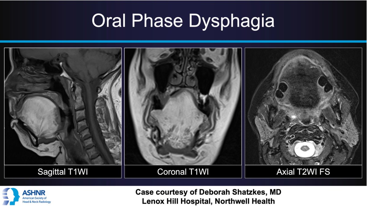 ASHNR (@ashnrsociety) on Twitter photo #ASHNRCOTW #141: Oral phase dysphagia. Dx? Thx <a href="/DShatzkes/">Deborah Shatzkes</a> 4 case! #ASHNR21
Answer w/ appropriate GIF only -- stay professional & don't spoil it!
<a href="/IlonaSchmalfuss/">Ilona Schmalfuss</a> <a href="/callyrobs/">Caroline Robson, MBChB</a> <a href="/CDP_Rad/">C Douglas Phillips 🇺🇸</a> <a href="/rhwiggins/">Richard Wiggins</a> <a href="/nakoontz/">Nicholas Koontz</a> <a href="/cmtomblinson/">Courtney Tomblinson, MD</a> @CincyPedsNeuro <a href="/ESHNRSociety/">ESHNR</a> <a href="/TheASNR/">The American Society of Neuroradiology</a> <a href="/AnnJayMD1/">Ann Jay MD</a> <a href="/RadRupa/">Rupa Radhakrishnan</a> #ASHNRCOTW #141: Oral phase dysphagia. Dx? Thx <a href="/DShatzkes/">Deborah Shatzkes</a> 4 case! #ASHNR21
Answer w/ appropriate GIF only -- stay professional & don't spoil it!
<a href="/IlonaSchmalfuss/">Ilona Schmalfuss</a> <a href="/callyrobs/">Caroline Robson, MBChB</a> <a href="/CDP_Rad/">C Douglas Phillips 🇺🇸</a> <a href="/rhwiggins/">Richard Wiggins</a> <a href="/nakoontz/">Nicholas Koontz</a> <a href="/cmtomblinson/">Courtney Tomblinson, MD</a> @CincyPedsNeuro <a href="/ESHNRSociety/">ESHNR</a> <a href="/TheASNR/">The American Society of Neuroradiology</a> <a href="/AnnJayMD1/">Ann Jay MD</a> <a href="/RadRupa/">Rupa Radhakrishnan</a>
