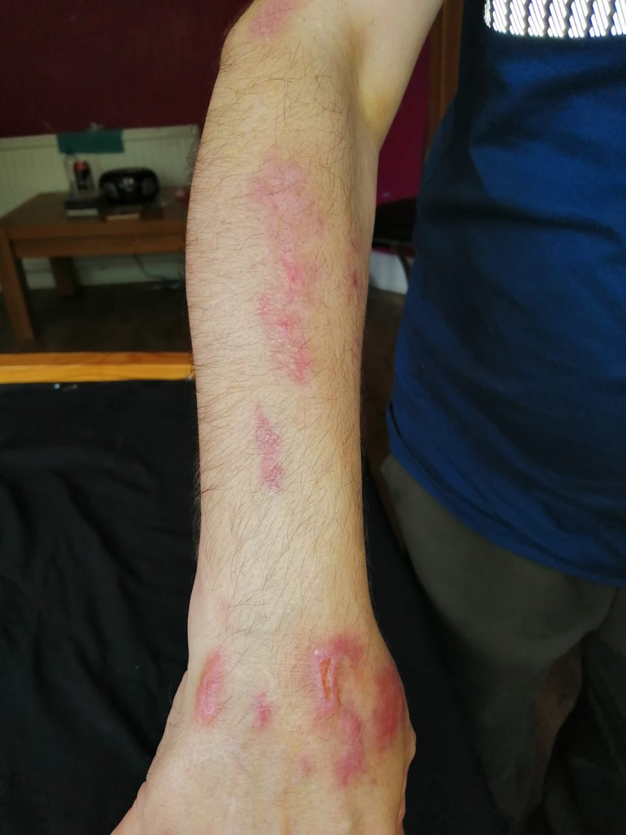 TandooriDal's tweet photo. PLEASE CAN YOU RT! Neglect in the care sector is a joke! This is Tony, Tony is a family member born with brain damage, yet he has managed to injure himself in what is supposedly 24hr care and the carers have no idea how he did it! this is NOT ACCEPTABLE!! Accountability is needed https://t.co/F7iK7yr7uR
