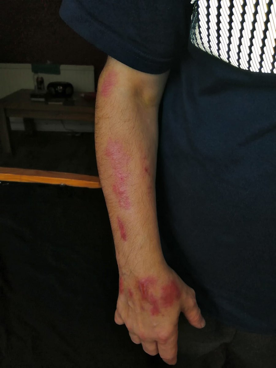 TandooriDal's tweet photo. PLEASE CAN YOU RT! Neglect in the care sector is a joke! This is Tony, Tony is a family member born with brain damage, yet he has managed to injure himself in what is supposedly 24hr care and the carers have no idea how he did it! this is NOT ACCEPTABLE!! Accountability is needed https://t.co/F7iK7yr7uR